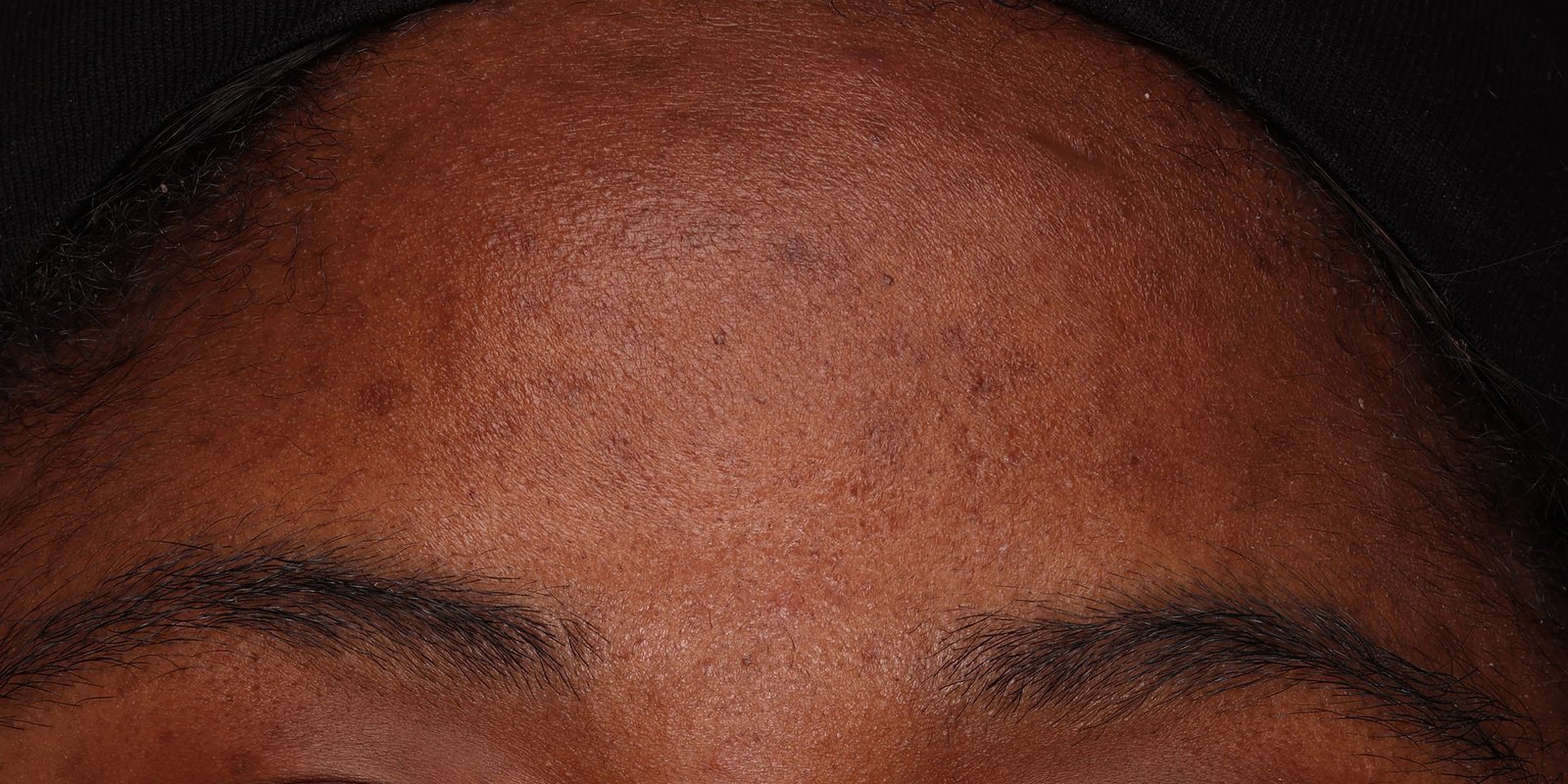 Close-up of woman's skin after using USRx HyperCorrect Treatment