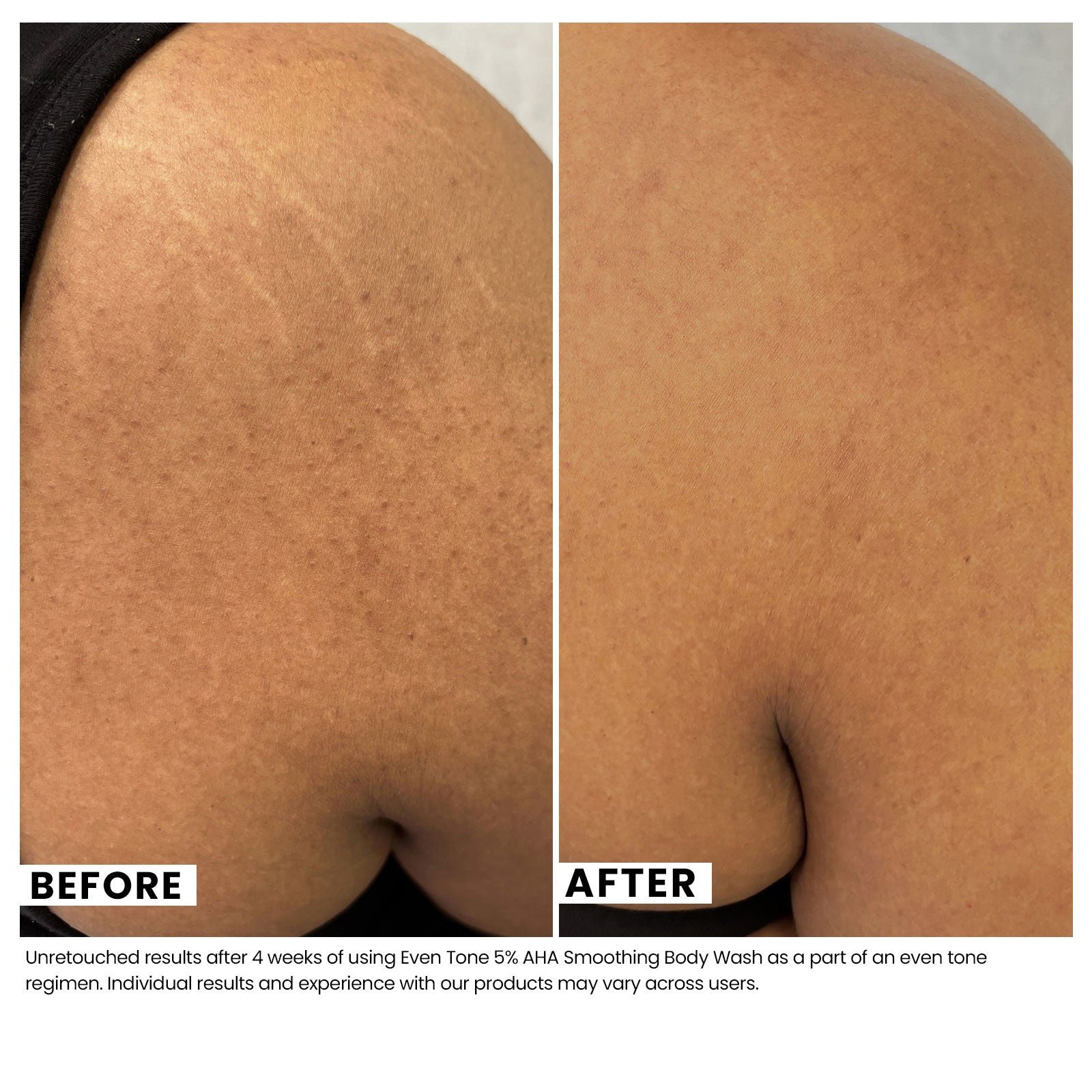Comparison of woman's skin before and after using USRx Even Tone Smoothing Body Wash